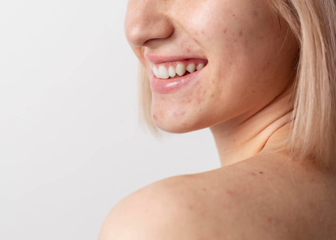 Peeling acné à Montpellier | peeling visage acné | Médecine esthétique | Clinique beauté