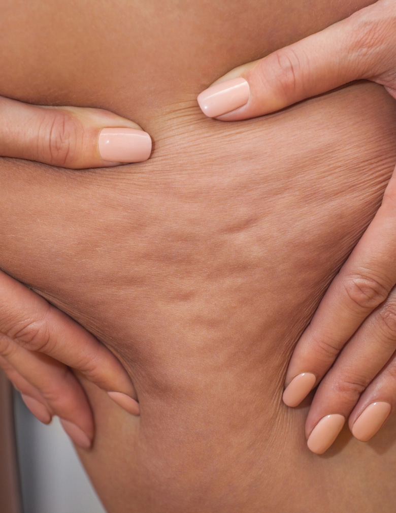 Femme qui montre la cellulite sur son ventre j ai de la cellulite - Hind clinique de beaute Montpellier